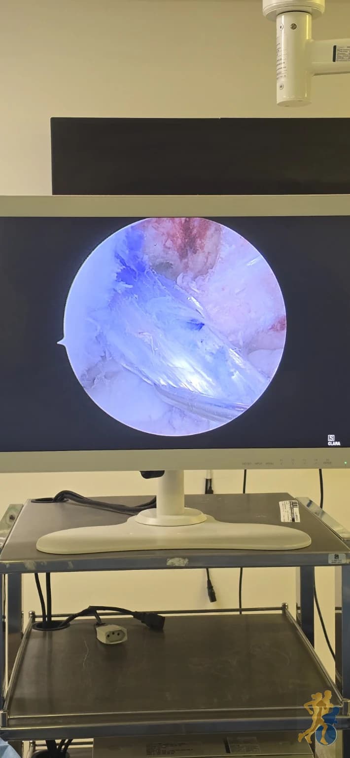 Visão artroscópica durante procedimento do ligamento cruzado anterior