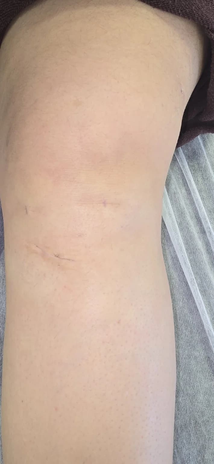 Exemplo de aspecto das incisões após reconstrução do LCA