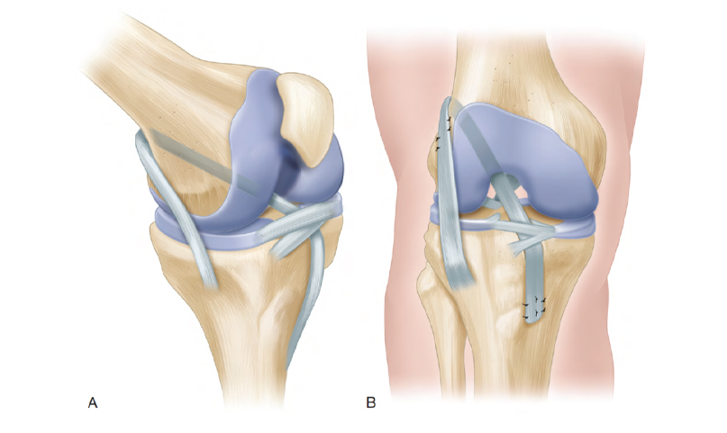 Lesão do ligamento cruzado anterior (LCA) do joelho na infância e adolescência